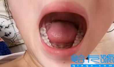 拍片有智齿一定会长吗(拍片有智齿一定要拔吗)