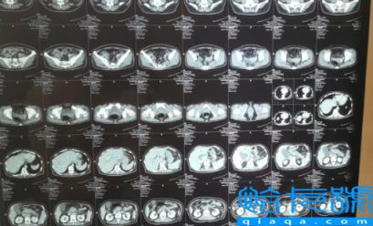 胰腺不舒服早期大便会变化吗(胰腺不舒服早期胰腺炎注意哪些饮食)