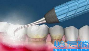 美容医院洗牙靠谱吗(​洗牙去美容院好还是口腔医院好)