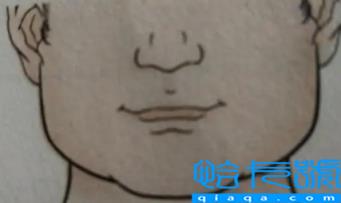 人中上的痣能去掉吗(人中上的痣代表什么)