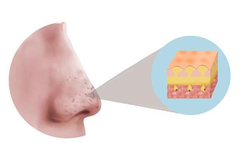 螨虫怎么去除最有效方法(螨虫叮咬后的症状图)