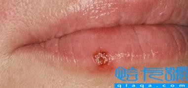 嘴唇疱疹结痂了能见水吗(嘴唇疱疹流水结痂怎么处理)
