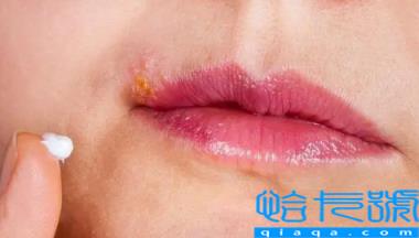 嘴唇疱疹结痂了能见水吗(嘴唇疱疹流水结痂怎么处理)