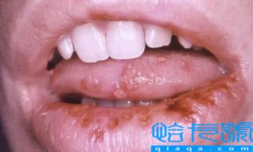 嘴唇疱疹结痂了可以接吻吗(嘴唇疱疹结痂后怎么周围还是红肿)