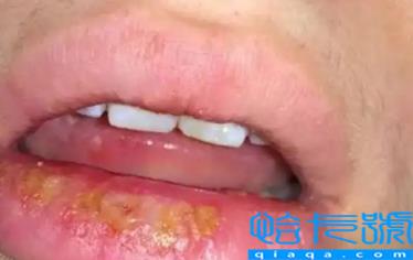 嘴唇疱疹结痂了可以接吻吗(嘴唇疱疹结痂后怎么周围还是红肿)