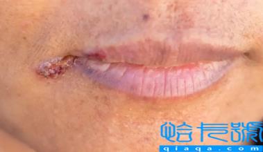 嘴唇疱疹结痂了可以接吻吗(嘴唇疱疹结痂后怎么周围还是红肿)