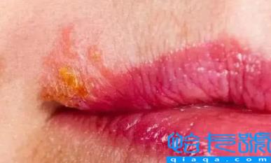 嘴唇疱疹不吃药可以自愈吗(口唇疱疹自己会好吗)
