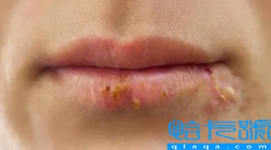 嘴唇疱疹不吃药可以自愈吗(口唇疱疹自己会好吗)