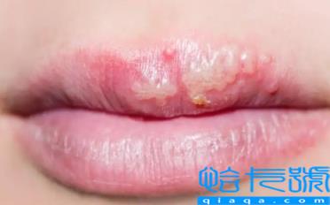 为什么每年嘴唇都长一次疱疹(每年嘴唇都要长疱疹怎么避免)