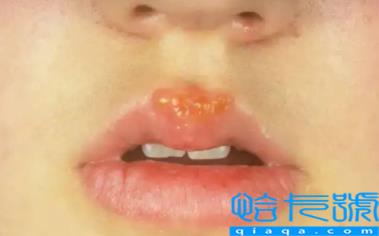 为什么每年嘴唇都长一次疱疹(每年嘴唇都要长疱疹怎么避免)