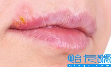 嘴唇疱疹会越来越多吗(嘴唇疱疹严重的话会怎么样)