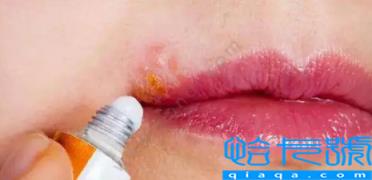 唇疱疹好后嘴巴反复蜕皮怎么回事(唇疱疹会导致嘴巴变形吗)
