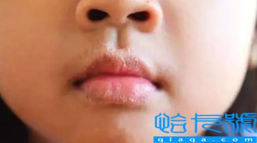 唇疱疹好后嘴巴反复蜕皮怎么回事(唇疱疹会导致嘴巴变形吗)