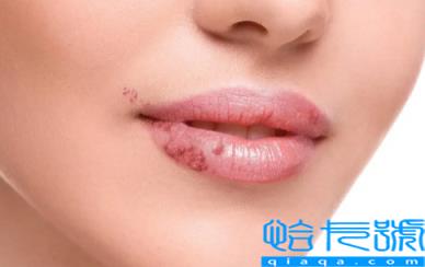 感冒了嘴唇疱疹怎么办(感冒了嘴唇疱疹用什么药)