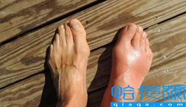 免疫吸附治痛风是用机器吗(免疫吸附治痛风的利弊)