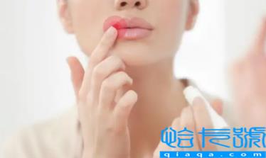 口唇疱疹结痂了怎么好得快(唇疱疹结痂后还需要注意什么)