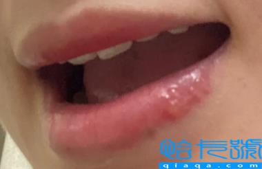 口唇疱疹结痂了怎么好得快(唇疱疹结痂后还需要注意什么)