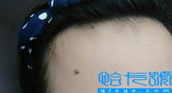 嘴巴下的痣可以去掉吗(有的痣不能点是不是真的)