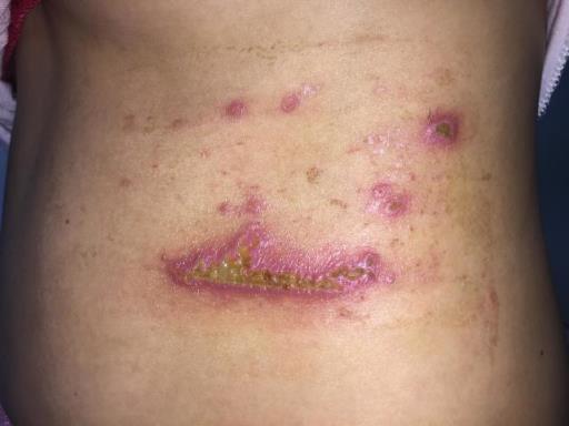 隐翅虫引起的皮炎特别疼！(隐翅虫皮炎初期图片)