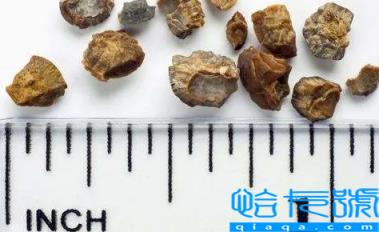 肾结石3mm需要治疗吗(肾结石3mm怎么才能快速排出来)