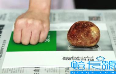 肾结石3mm需要治疗吗(肾结石3mm怎么才能快速排出来)