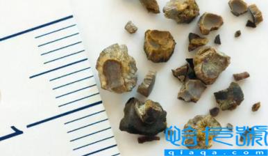 肾结石3mm×3mm多大(肾结石3mm严重吗)